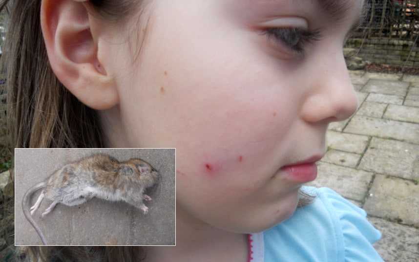 dziecko pogryzione przez szczura