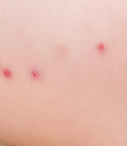 Ugryzienia meszki delikatne